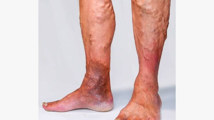 varicose vein issue